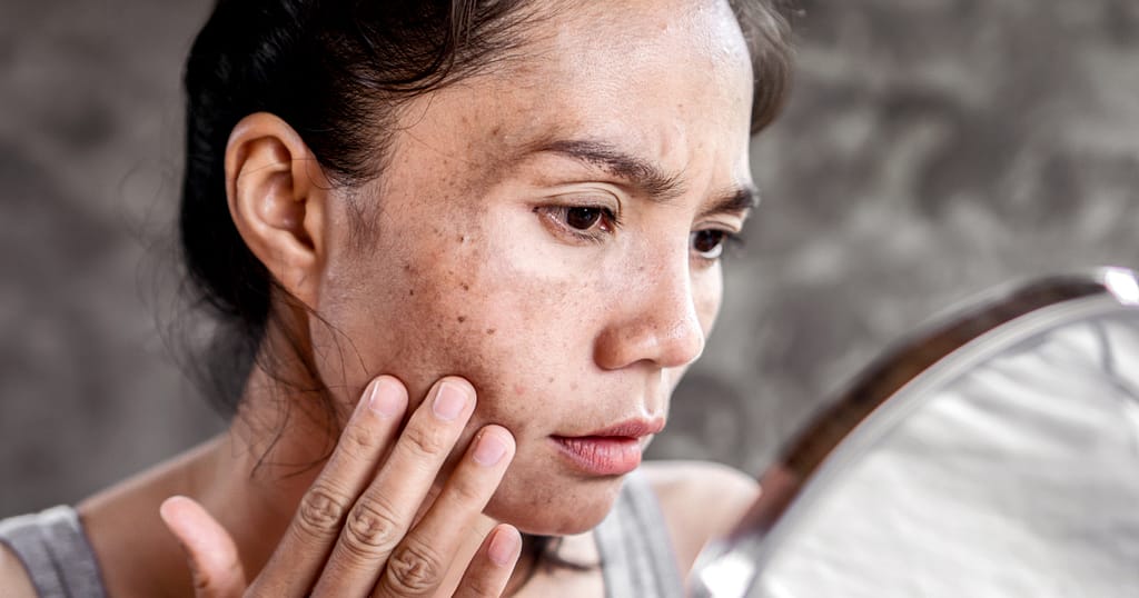 best chemical peels for hyperpigmentation