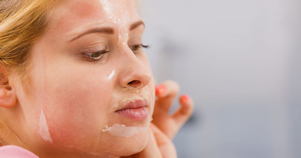 chemical peels for the treatment of hyperpigmentation