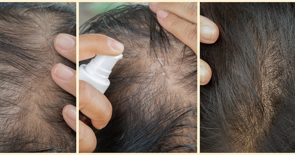 does minoxidil work for bald spots?