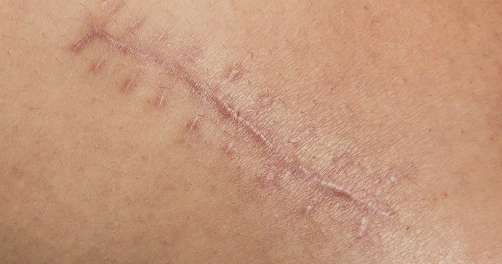 Microneedling for stretch marks on thighs Microneedling for stretch marks on stomach