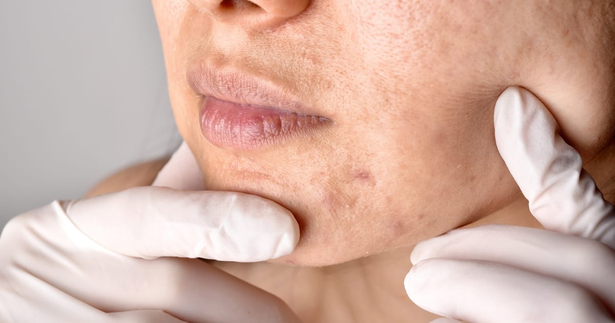 evaluating symptoms of sebaceous hyperplasia