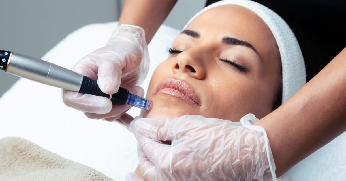 microneedling before and after