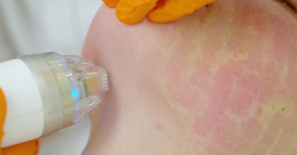 skn after micro-needling procedure