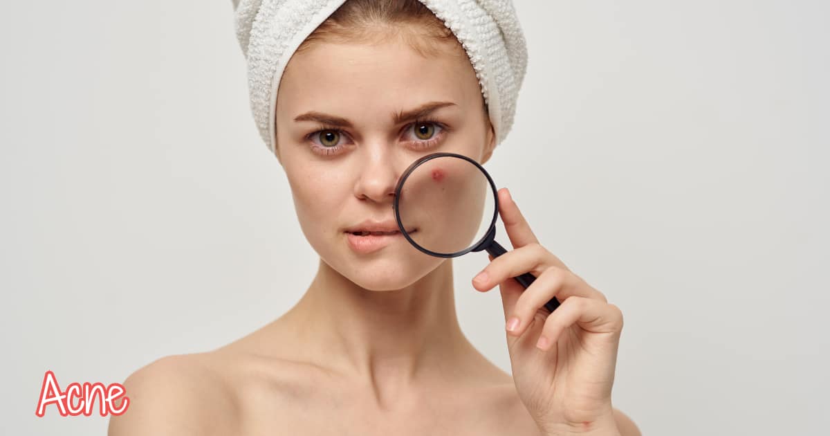 acne treatment with medical skin care product