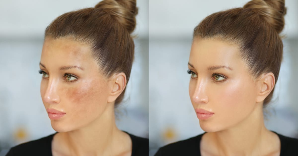 treatment of hyperpigmentation with medical-grade care