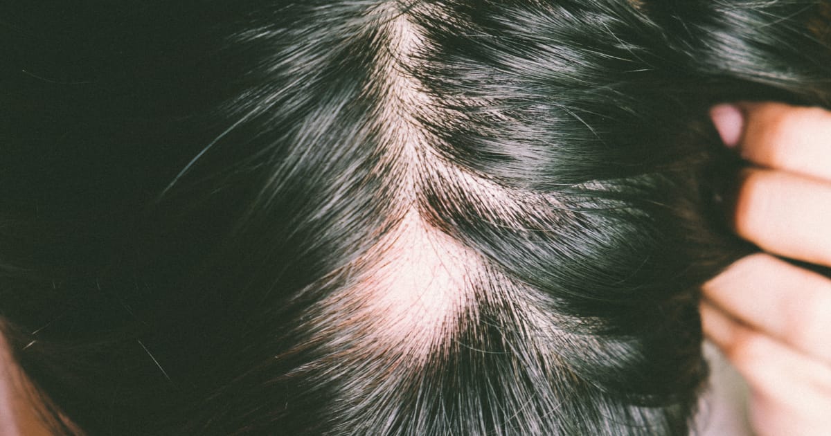 fastest way to regrow hair on bald spots