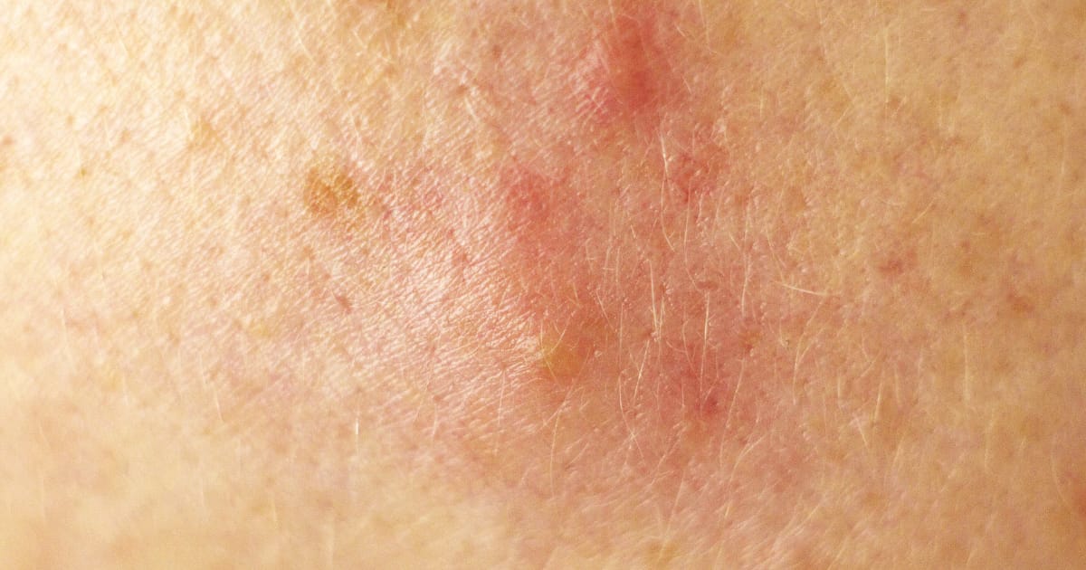 How to get rid of whiteheads