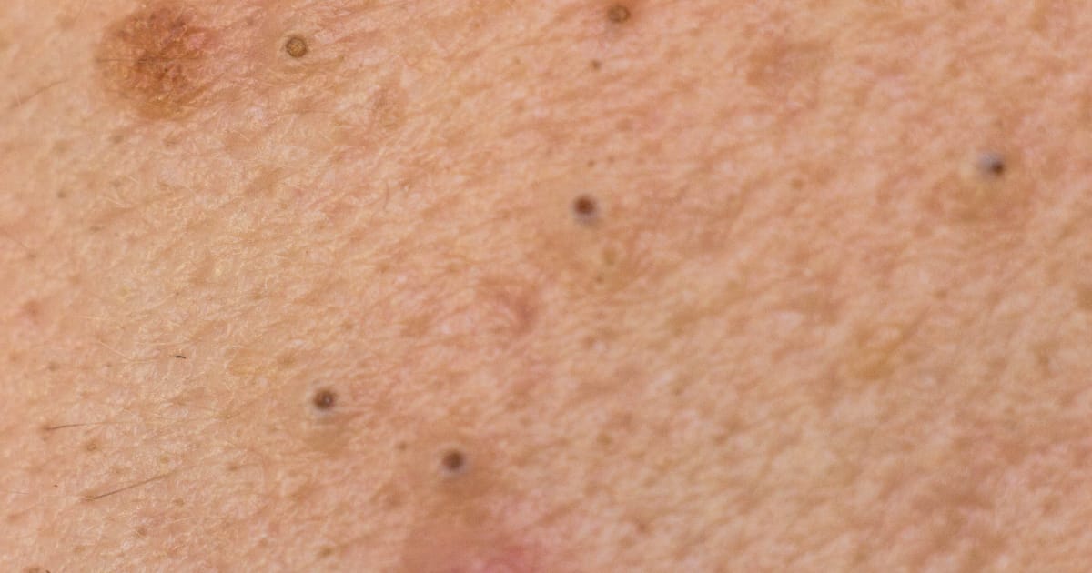 How to get rid of blackheads