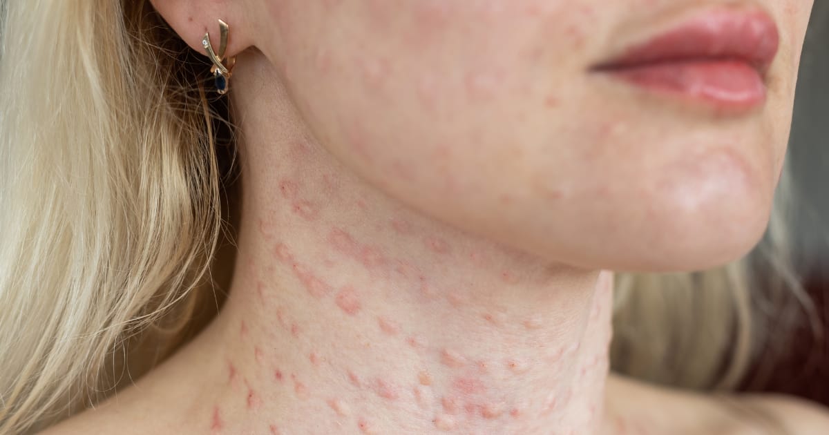 How to get rid of Papules and Pustules