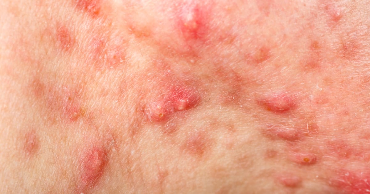 How to get rid of painful cystic acne and nodules