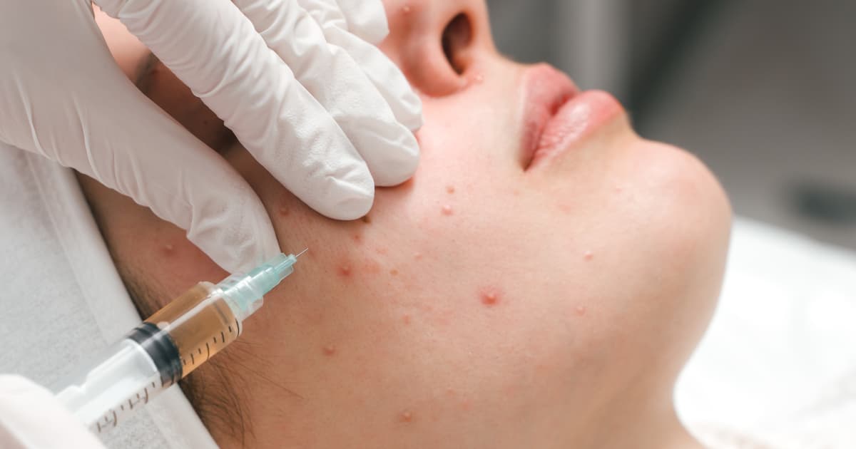 How to get rid of cystic acne and white head acne with a dermatologist