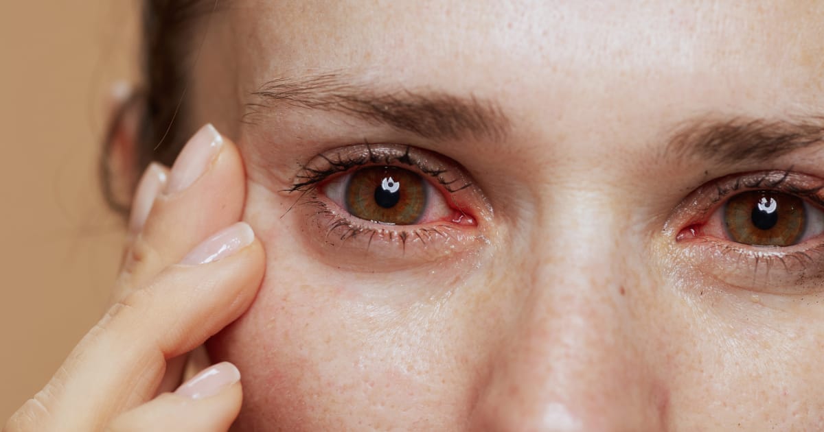 vitamin deficiency dry eyes