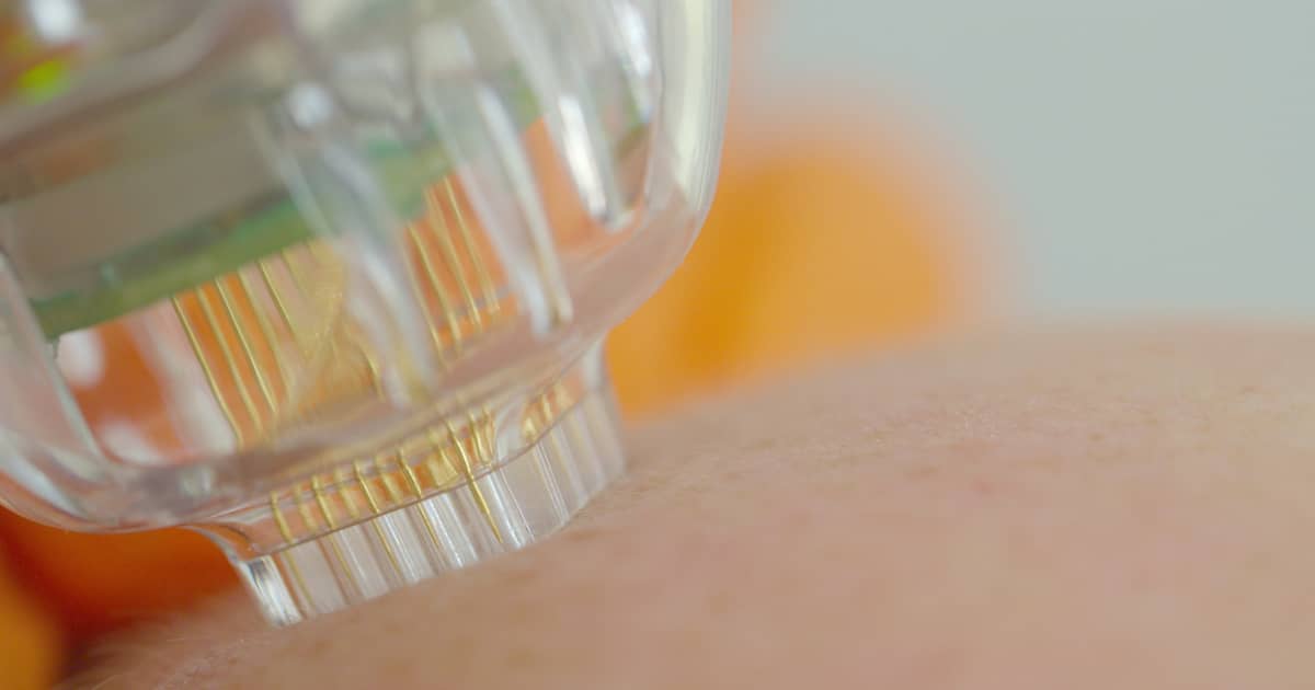 Best treatment for pregnancy stretch marks Microneedling for post-pregnancy scars Skin rejuvenation for stretch marks