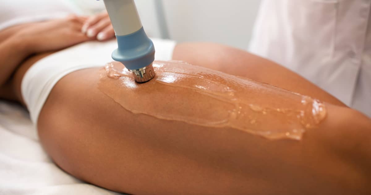 At-home microneedling for stretch marks Professional microneedling cost for stretch marks